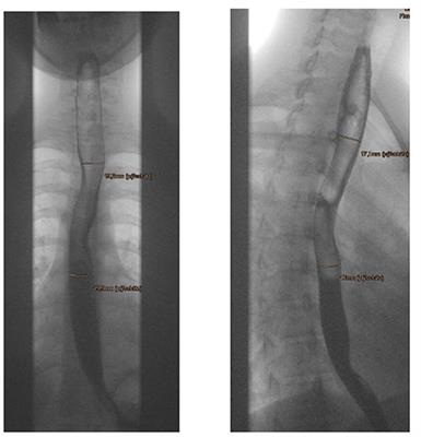 Esophageal Diameter as a Function of Weight in Neonates, Children and Adolescents: Reference Values for Dilatation of Esophageal Stenoses